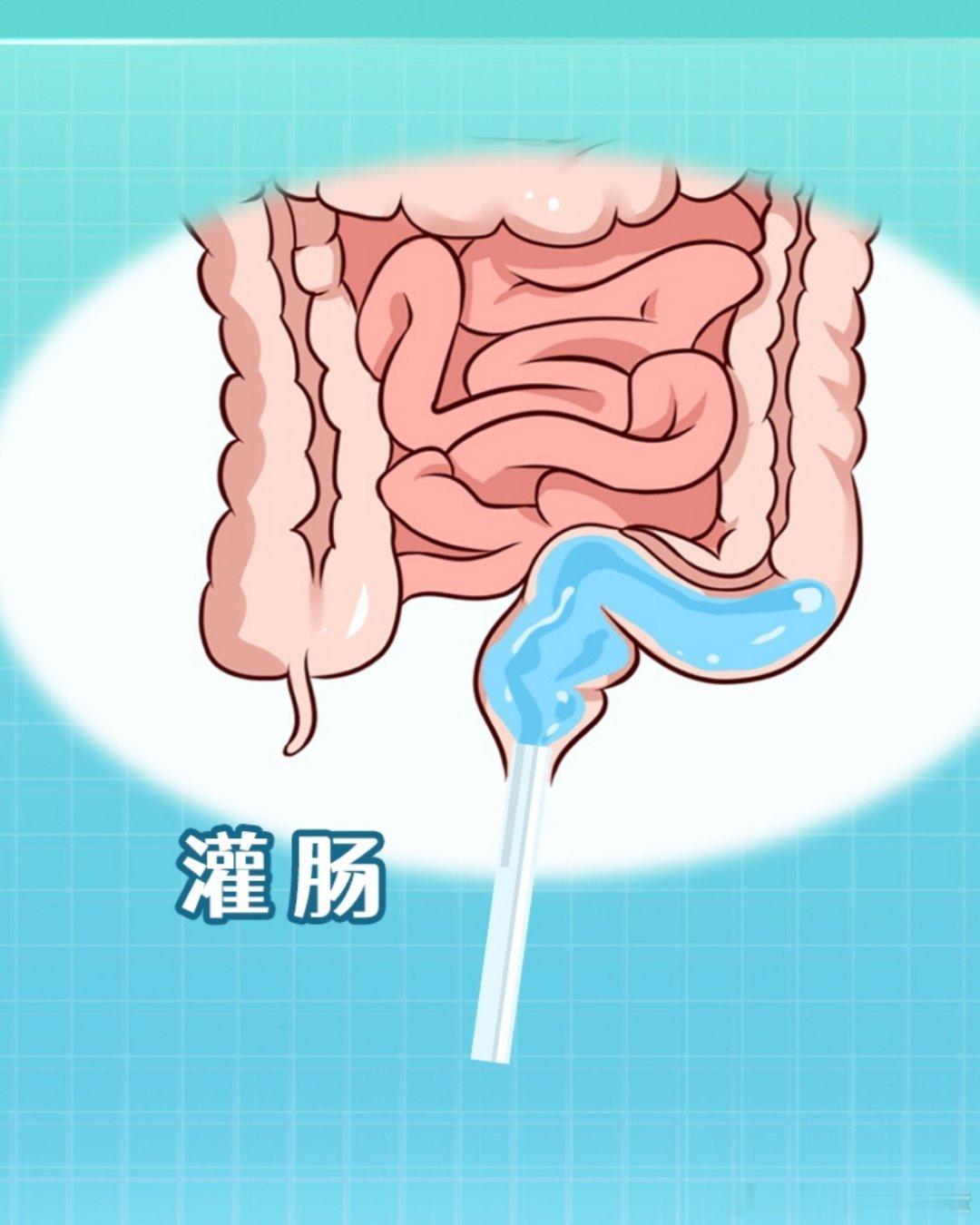 王灿被骗灌肠健闻登顶计划 “灌肠”真的能“排毒”？灌肠是将液体经肛门灌入直肠或结