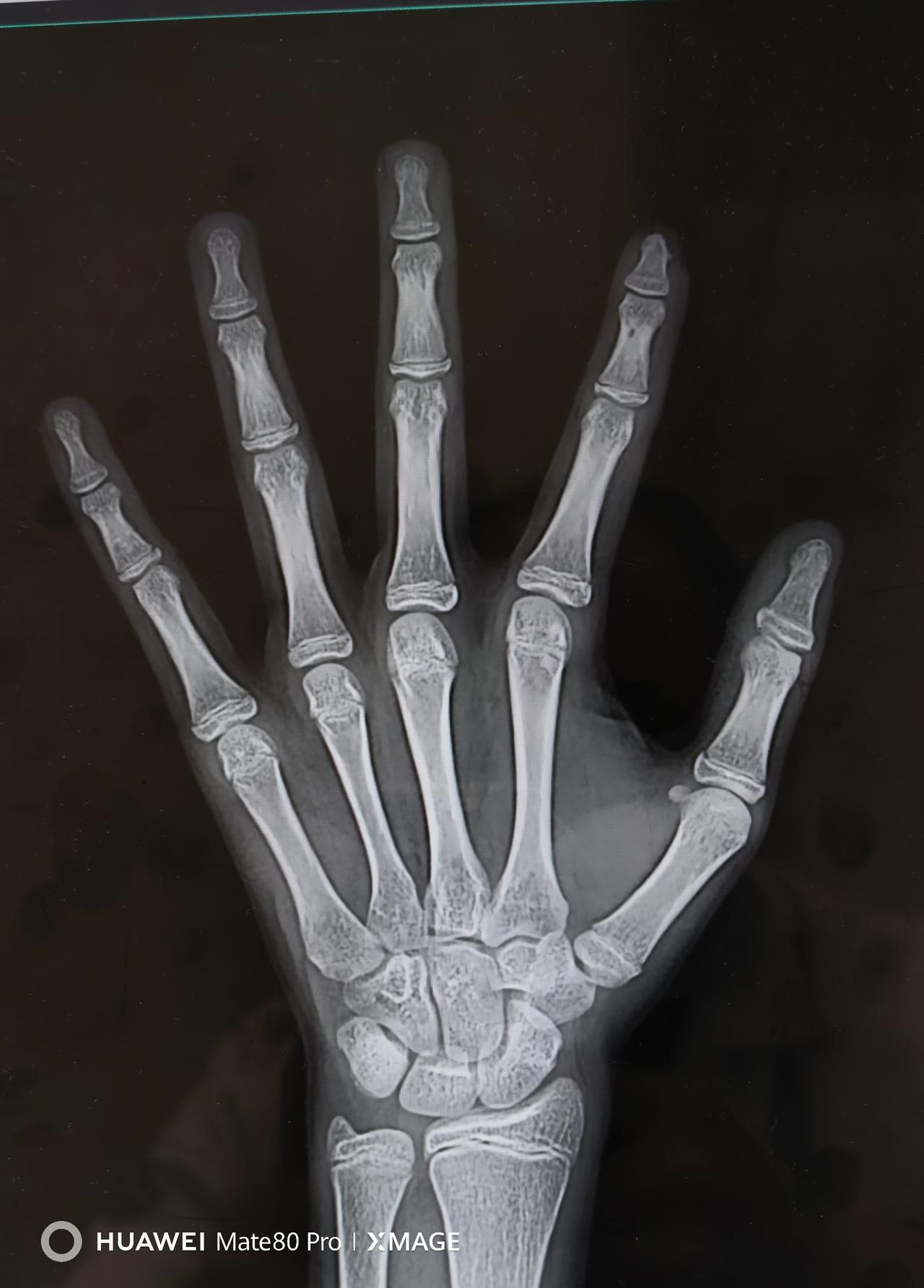 今天门诊遇到一个让我印象很深的小姑娘，13岁6个月，月经初潮已经1年多了，来就诊