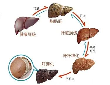 脂肪肝的7个明显症状，不重视可能会发展为肝癌、肝衰竭1. 乏力脂肪肝的一个常见症