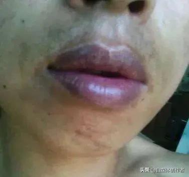 嘴唇发紫竟藏致命隐患！32岁博主被网友催检，查出心脏停搏2次险猝死
 
唇色发紫