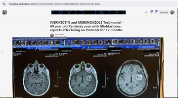 最新文章：伊维菌素和甲苯咪唑治疗见证——一位69岁的肯塔基州胶质母细胞瘤患者在接