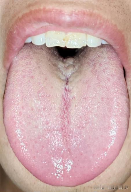 湿越重，肾越虚！两个中成药：参苓白术+桂附地黄 健脾祛湿固肾阳
这位粉丝，平时呢
