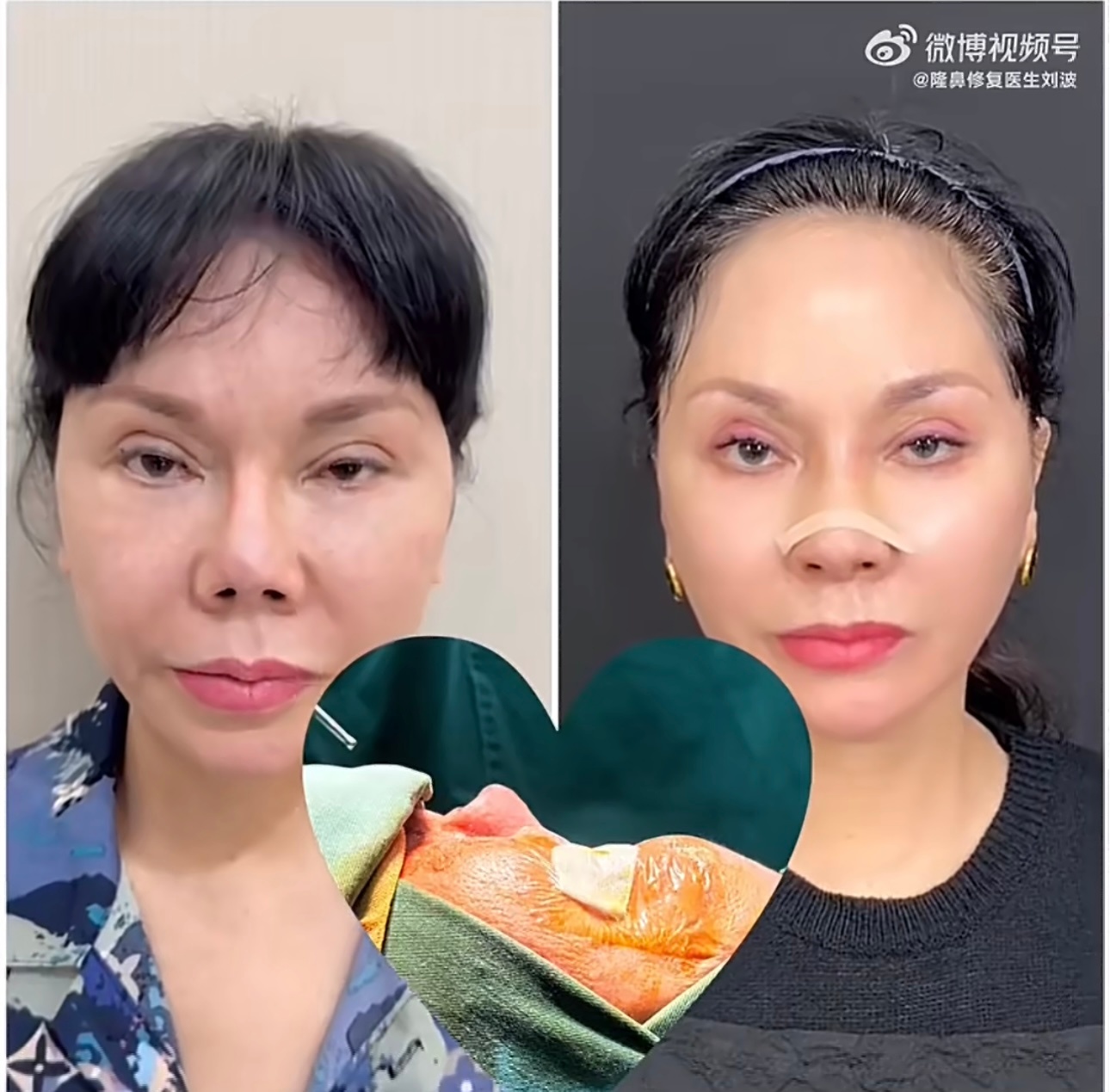 十几二十年前的纯硅胶L型假体鼻子，大把这种后面挛缩成这样的，很多人说之前的技术做