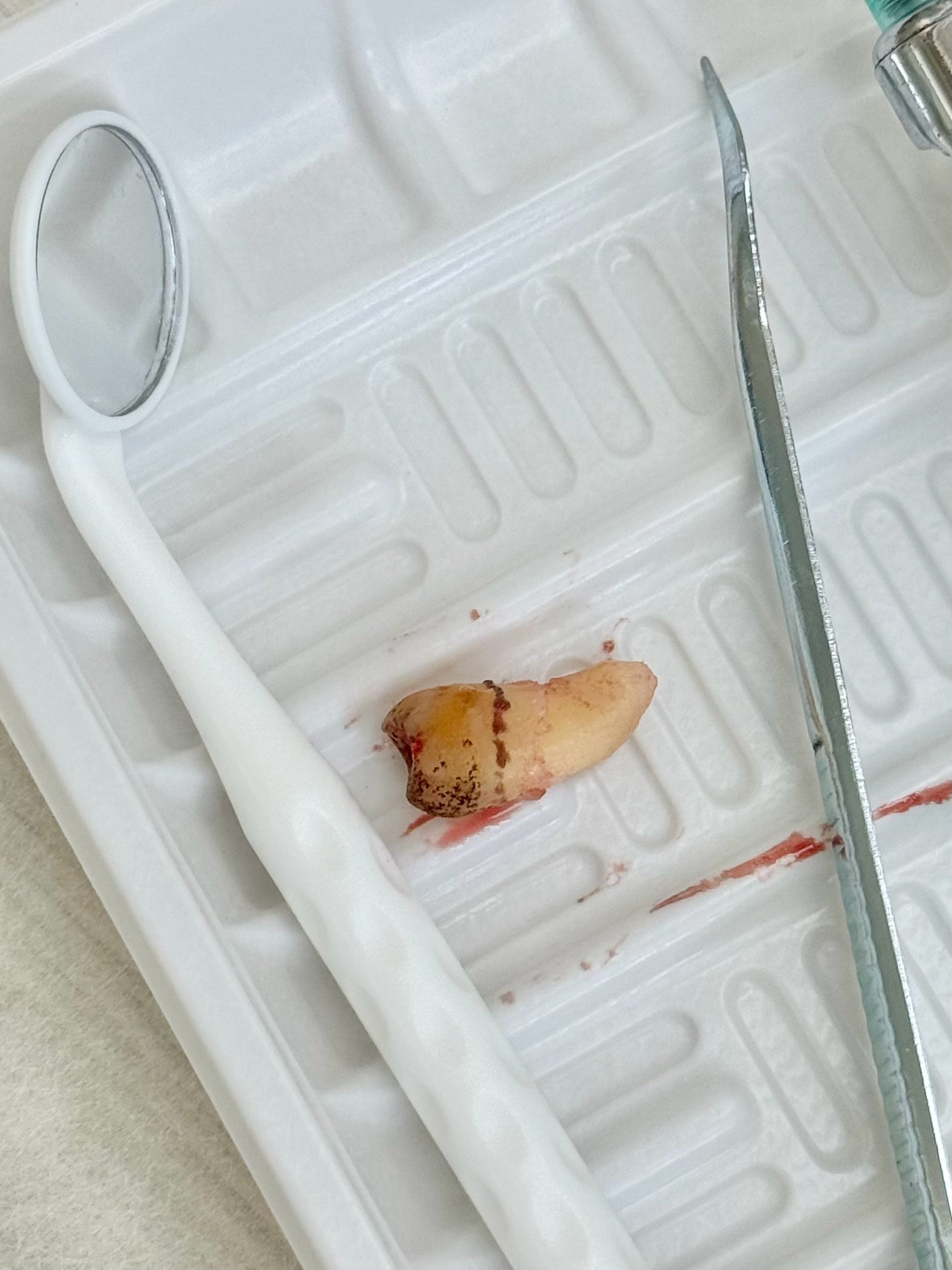 把最后一颗智齿拔了🦷最近大牙有点敏感医生检查说是牙龈有点萎缩了关系但程度还好 