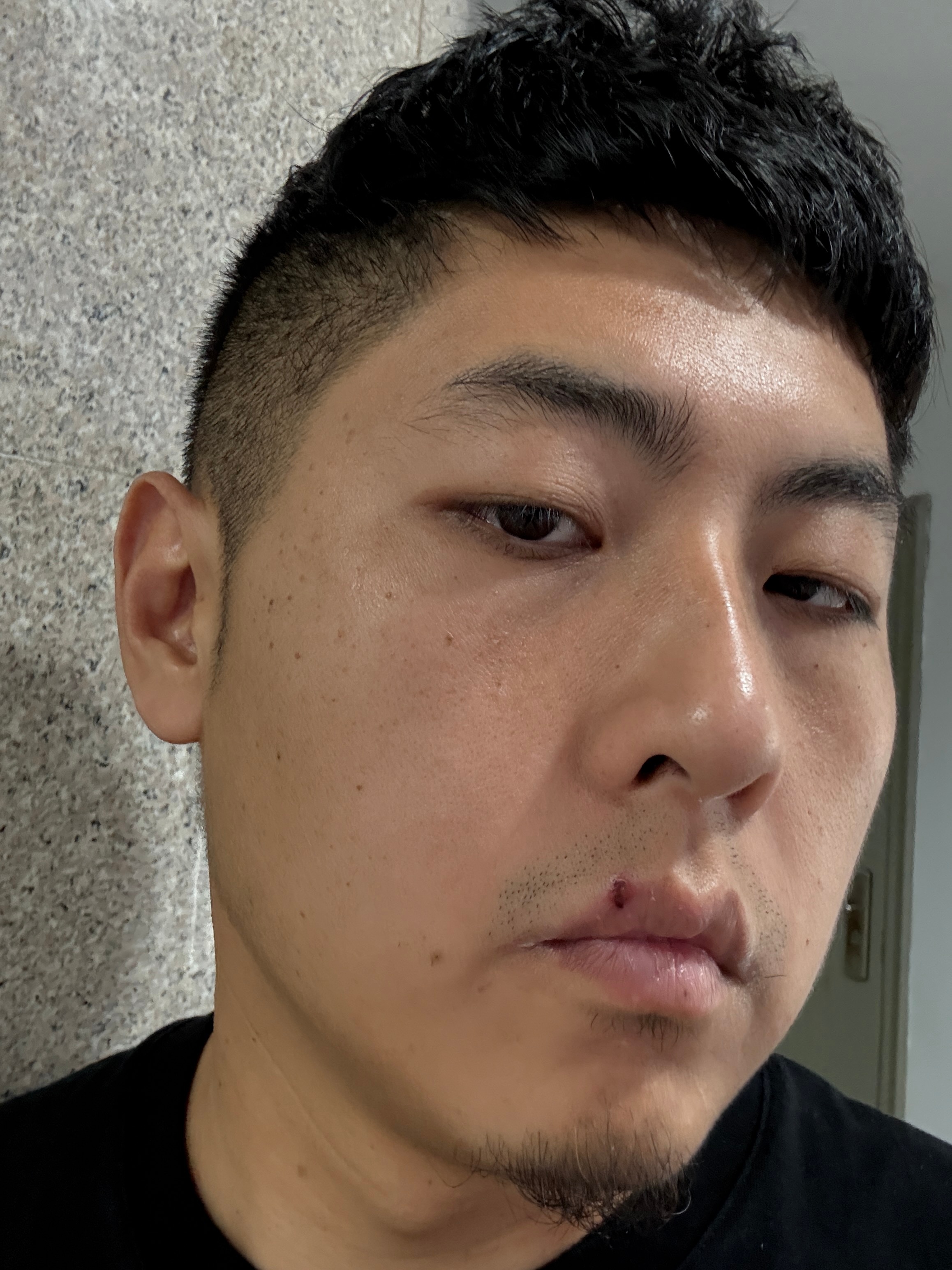 我媳妇说我脸上长了好多黑点，非让我来医院看看，结果一看是扁平疣...  要不要点