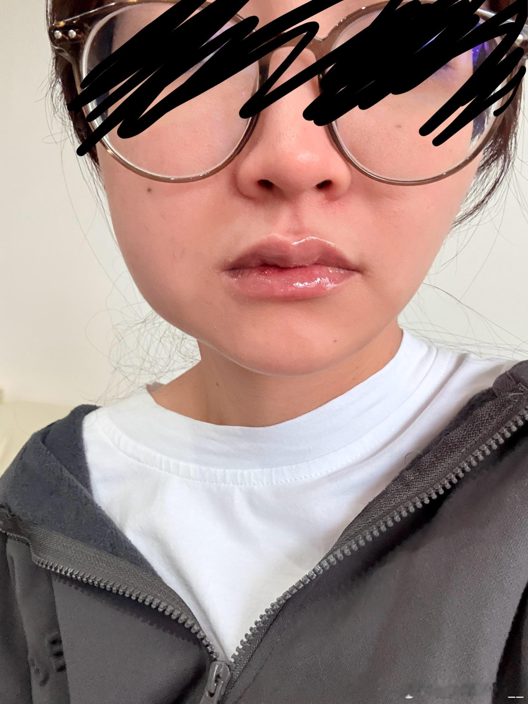 这嘴吃点流食都痛的不行了🙂‍↔️ 我的脸变形到搞笑🥸 ​​​