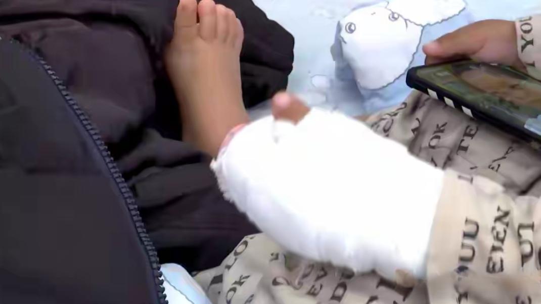 🔥揪心！云南2岁男童误玩鞭炮，左手被炸重伤，食指两节损毁无法保留，紧急送医手术