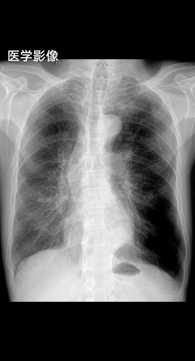 咳嗽胸闷，考虑慢支肺气肿？