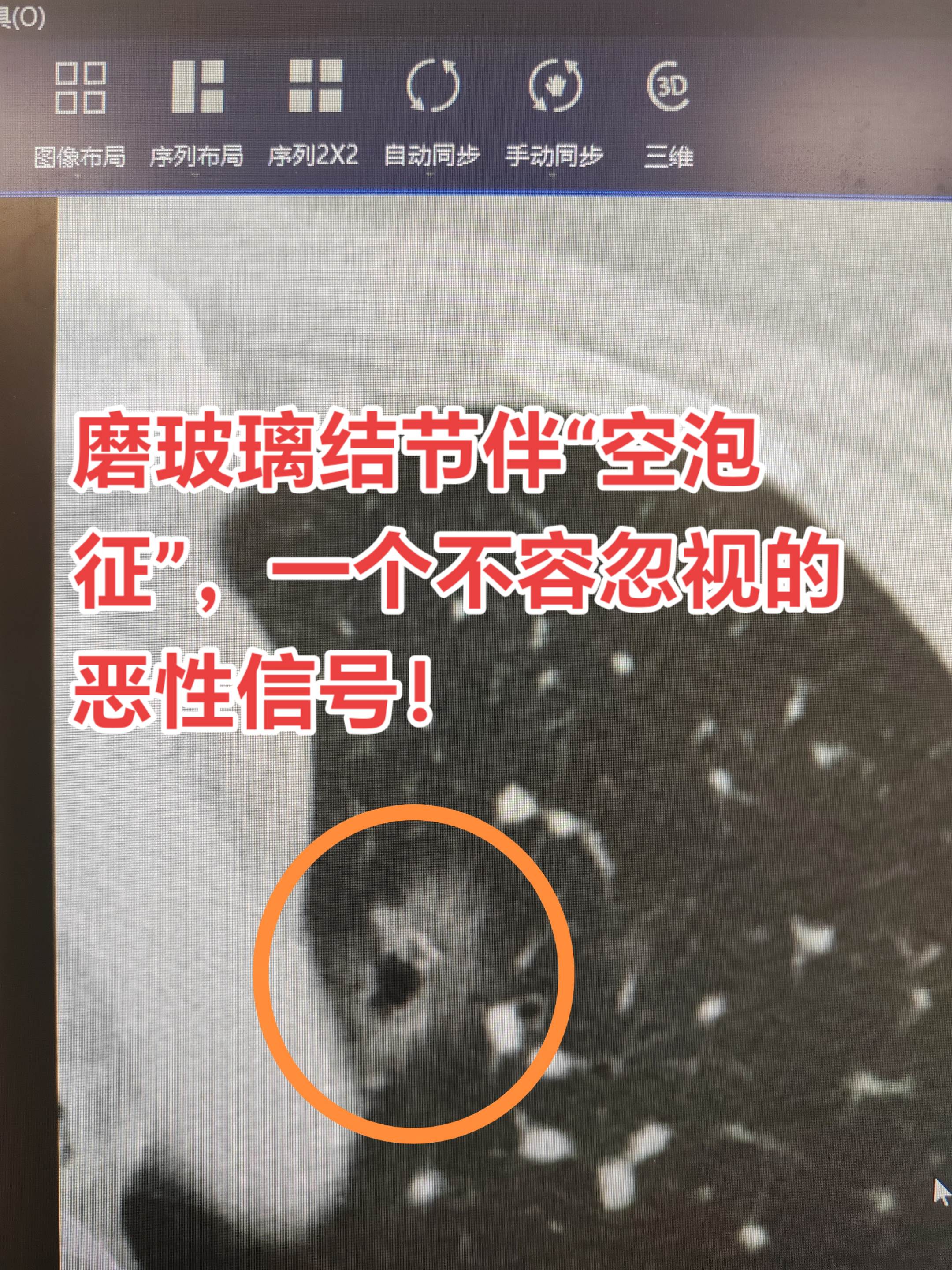 “空泡征”，一个不容忽视的恶性信号。当体检报告提示“肺磨玻璃结节”时...