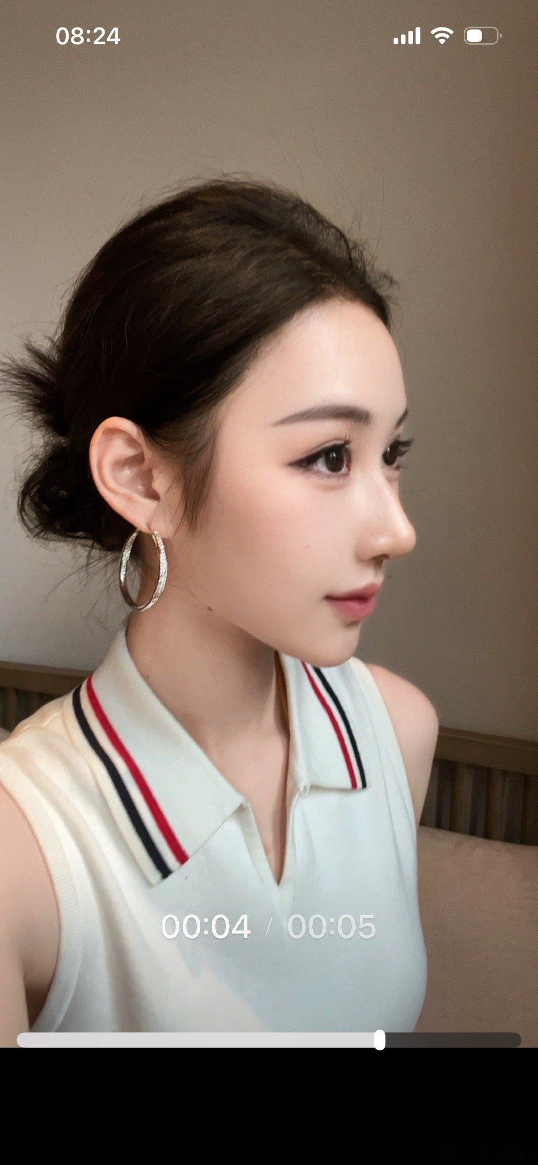 小助理给的返图肋骨鼻一个月复查形状最近感觉开始增生了，胶布贴鼻头转折点贴不下去，