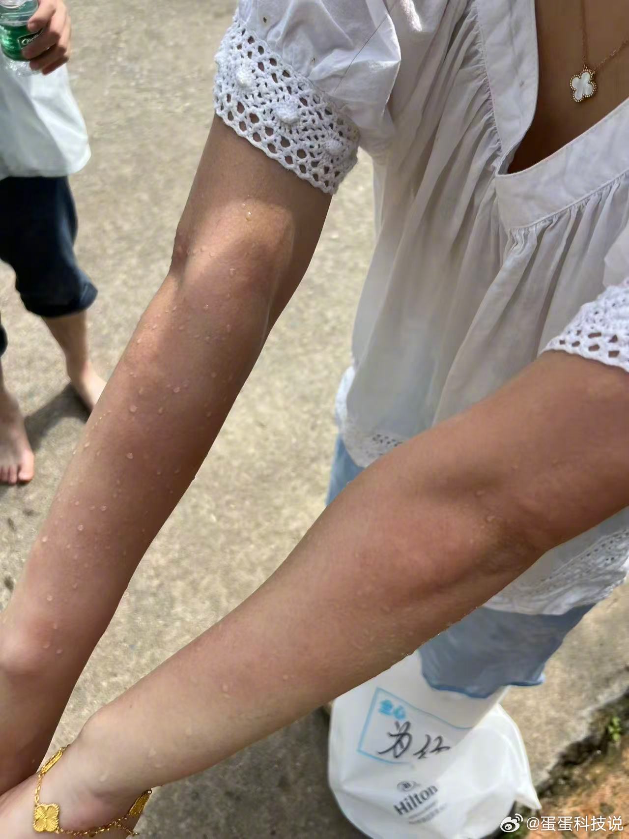 生活手记 这蚊子也太毒了吧，我的手要毁了