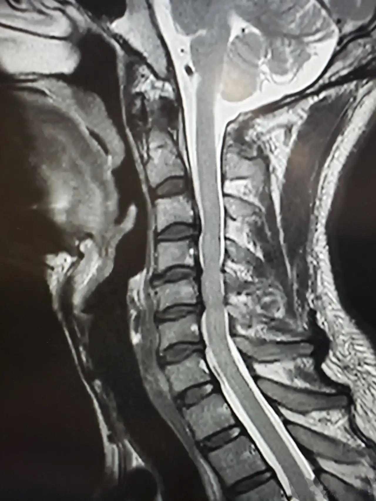 老人在日常如何避免得颈椎病　　1、注意颈部保暖。　　可以用厚的长围巾对脖子进行保