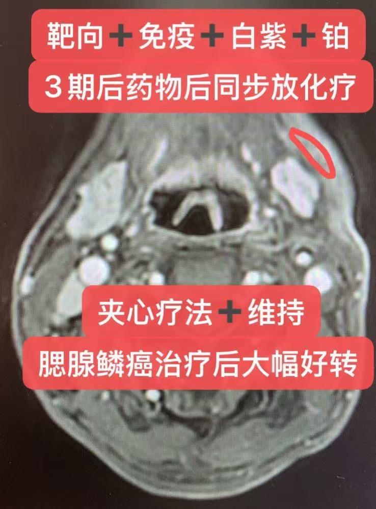 左侧颈部-腮腺鳞癌晚期全程治疗。1. 2025-05-22：左腮腺活检...