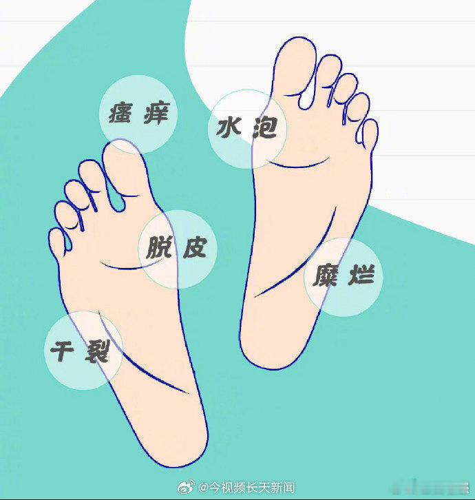【洞洞鞋其实是真菌滋生的温床】洞洞鞋里最好穿双袜子暨南大学附属第一医院皮肤科主任