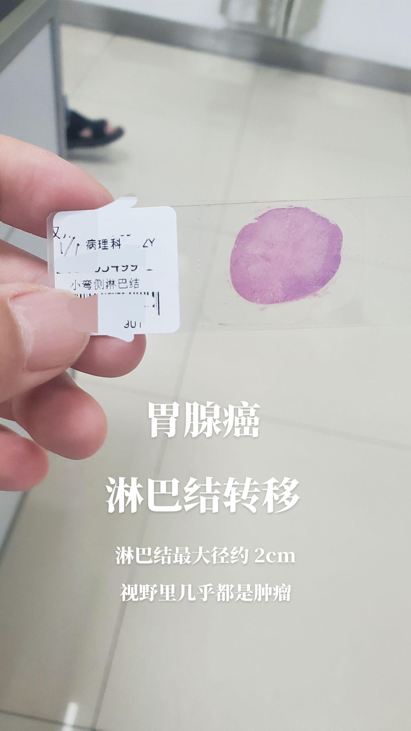 显微镜下的世界 
胃腺癌淋巴结转移