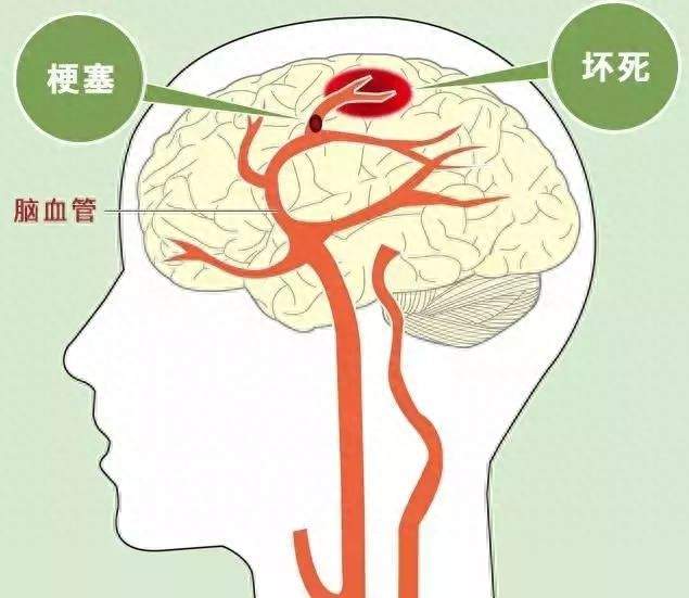 家人出现脑梗应该怎么办