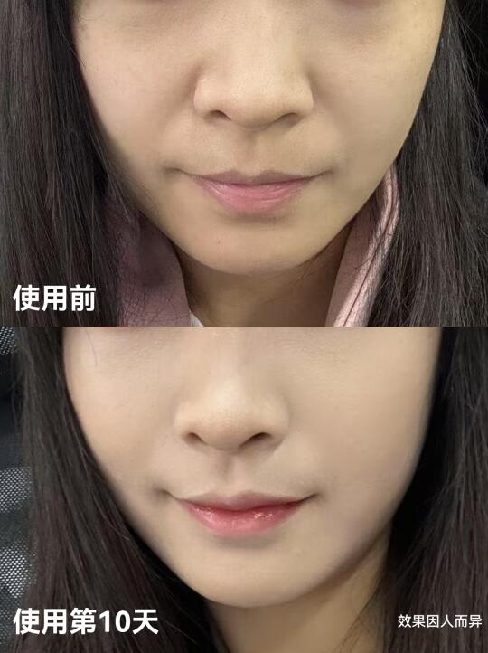 记录玛丽仙医用美容仪Pro+使用！真实记录