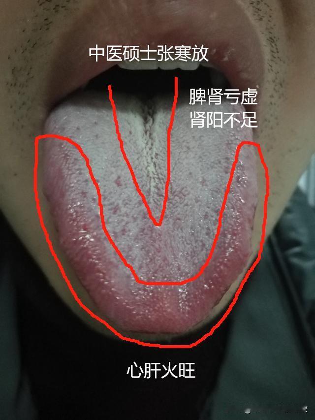 一吃泻火的药就拉肚子，一吃温阳的药就上火
这种矛盾的舌象，简直让人“欲仙欲死”[