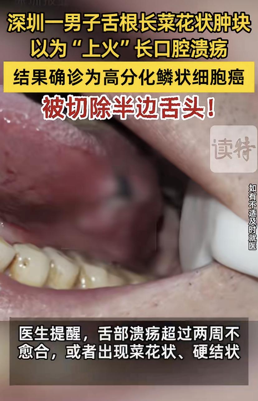 深圳41岁的陈先生舌头长了个菜花状肿块，又硬又凸，他以为是上火长溃疡，没当回事。