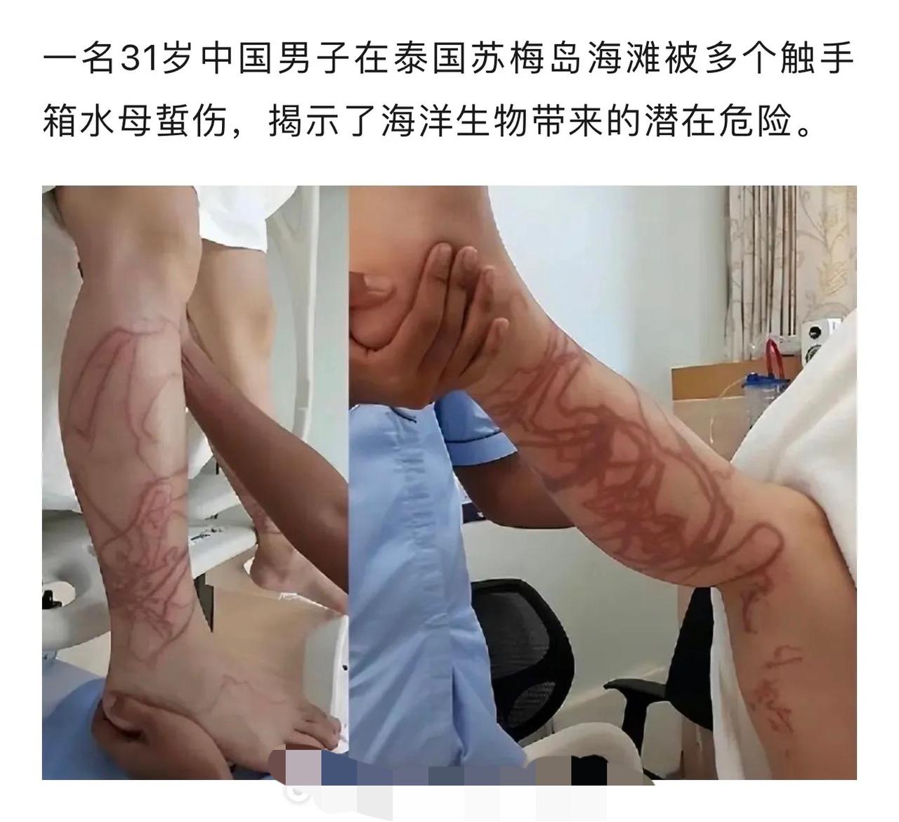 触手箱水母蜇伤，海洋生物的潜在危险！