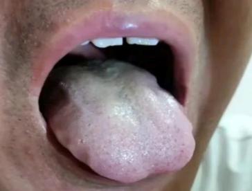 黄腻苔，就清热？大错特错！中医告诉你原因！

主诉：长期被头晕，耳鸣困扰，而且每
