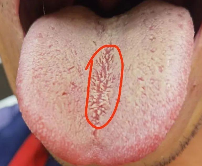 碰见这种裂纹舌，可不简单了，它有什么区别呢？
一般情况下出现裂纹舌，就是单纯的开