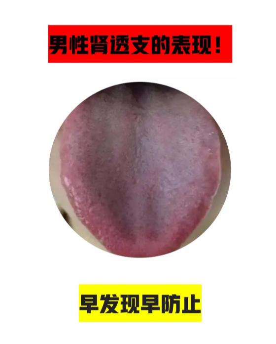 男性肾气透支的几大表现，别再忽视