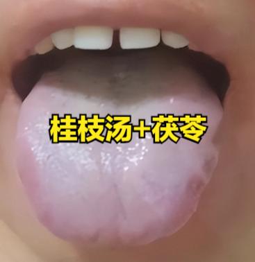 没有桂枝汤调和不了的病！加 1 味药，横扫各类虚损！从头补到脚！

一、加茯苓