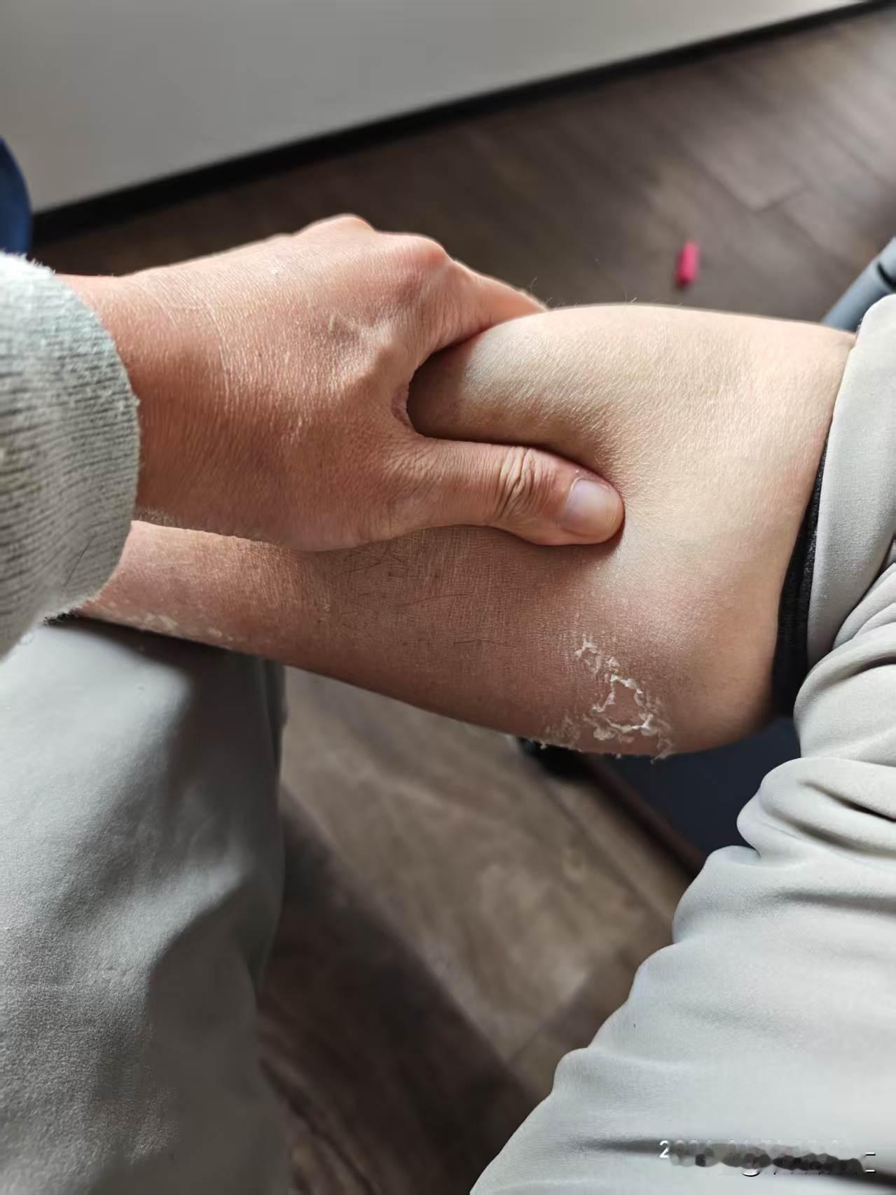 谁能给解释一下吗，为什么下个海就得脱层皮呢？
20年前，当时在青岛玩下海了。在大