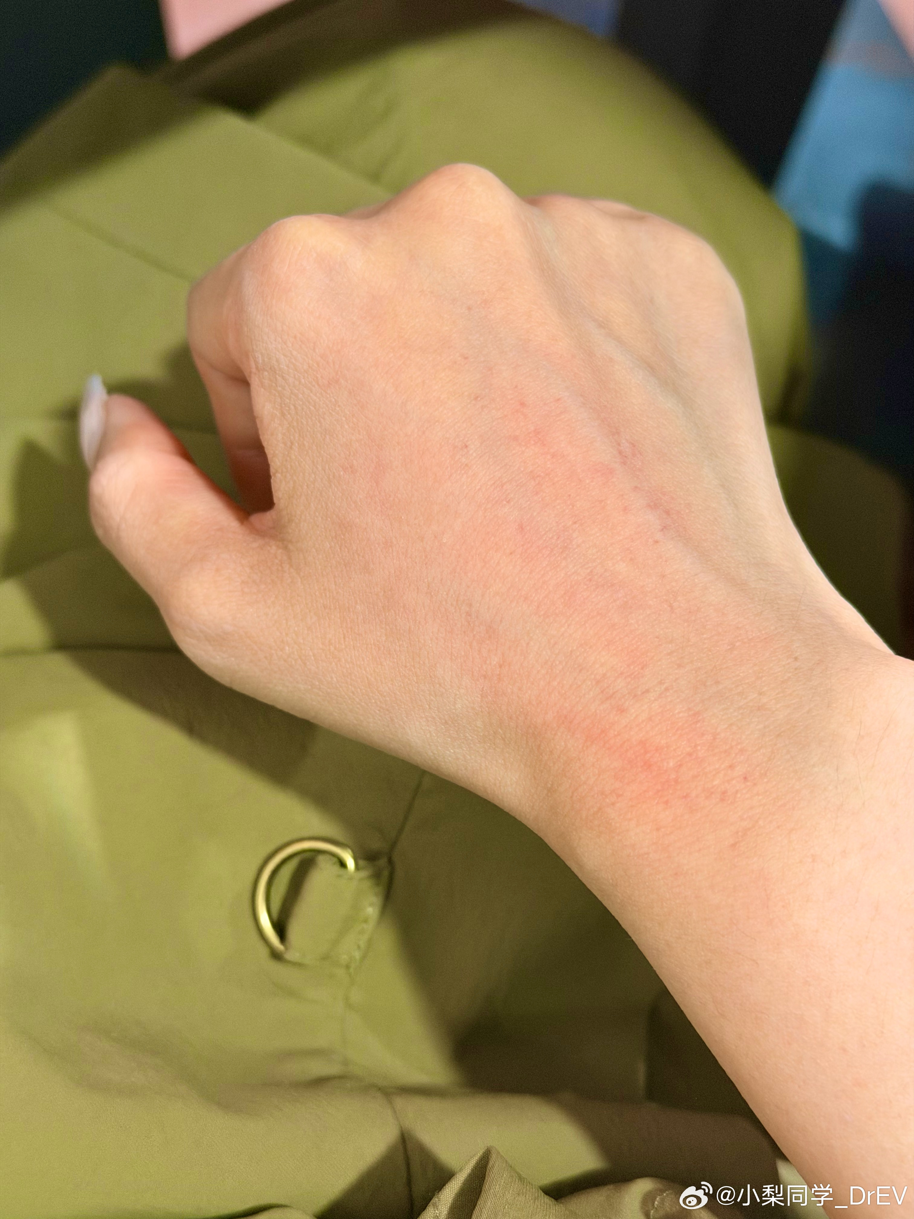 从西藏走后倒是没任何不适就是紫外线太高 日光性皮炎直接过敏再加今天在海边拍胳膊脖