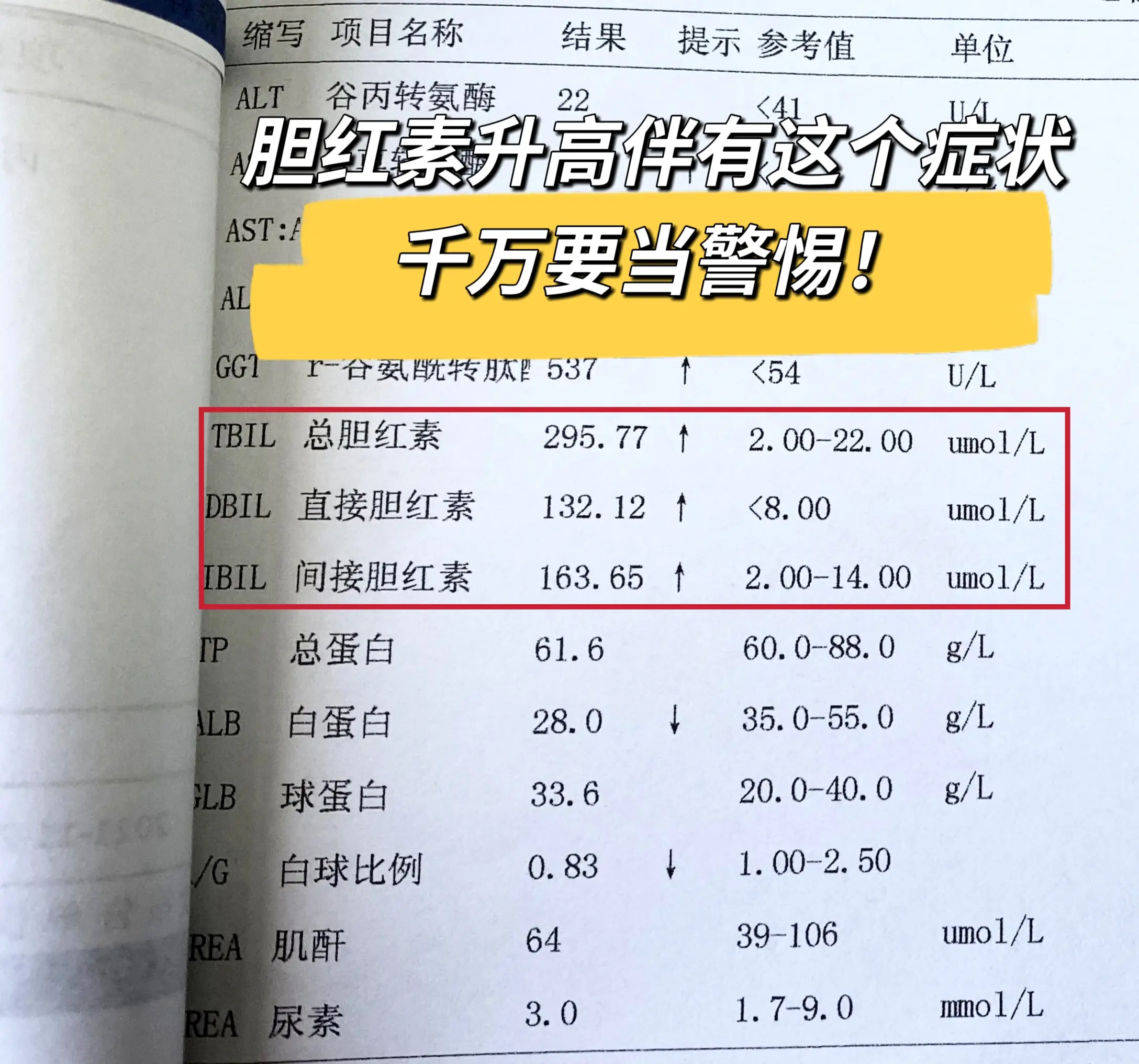 肝病患者注意！胆红素升高伴有这个症状的时候，就要警惕了！  这个症状就...