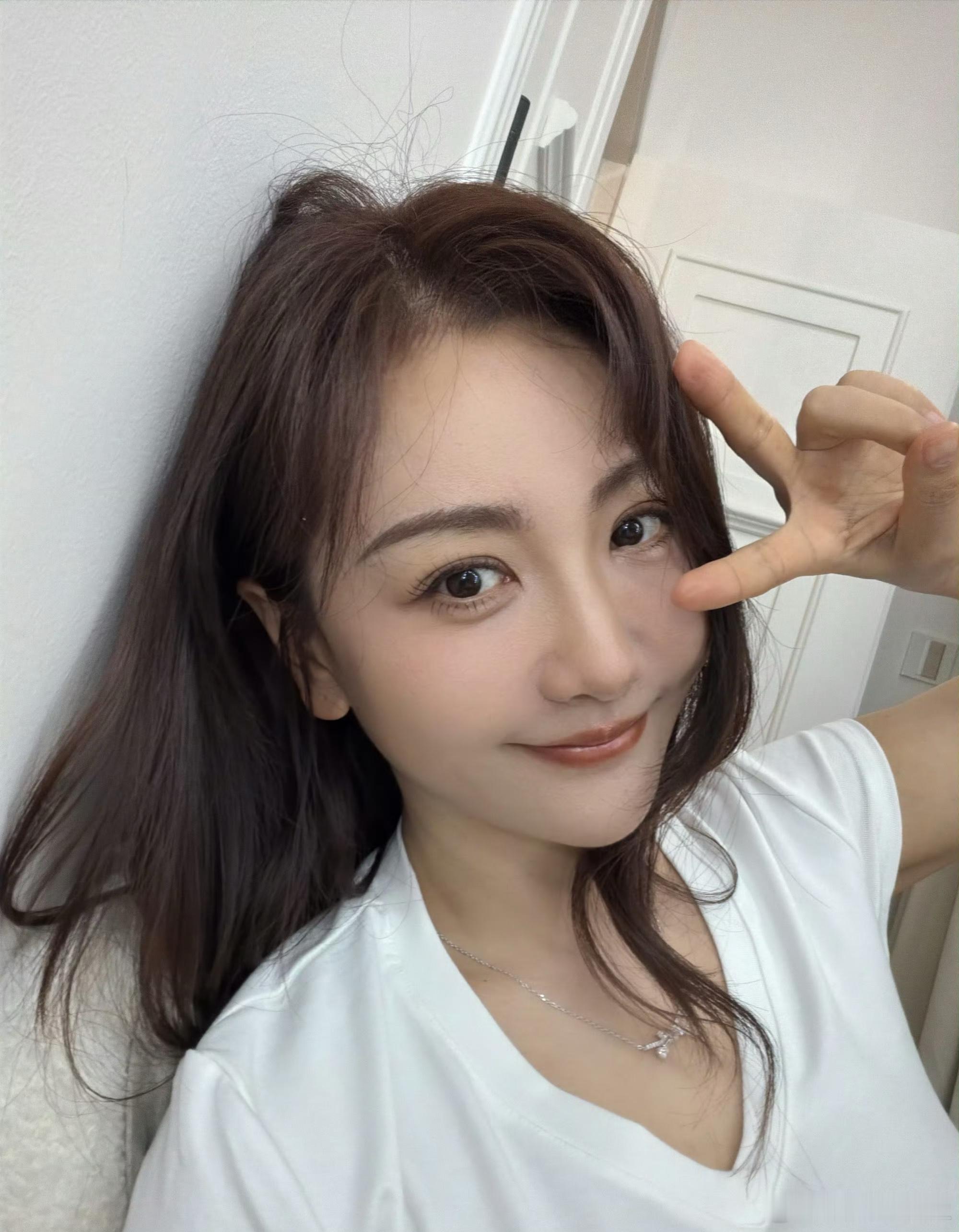 杨蓉面部烫伤恢复近照烫伤恢复需要时间，能坦然面对镜头已经很勇敢了