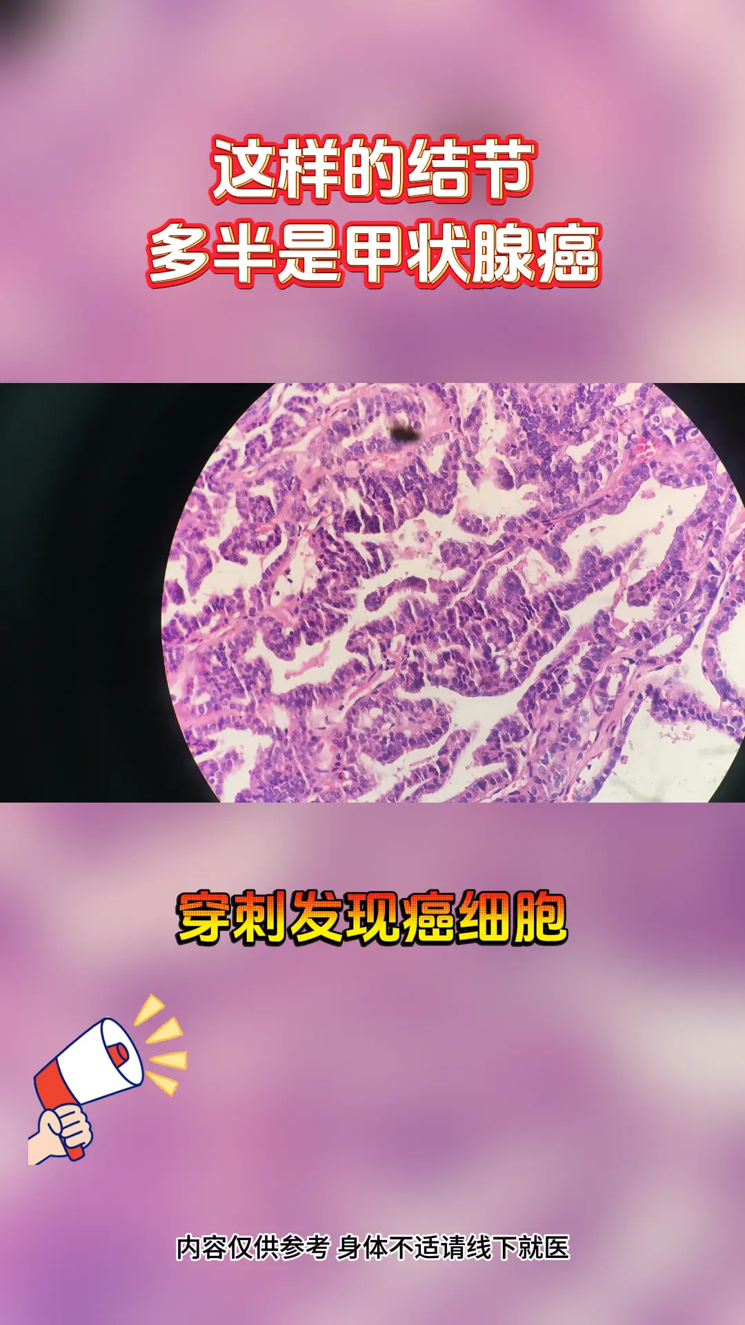 甲状腺结节 医学科普 知识科普 健康科普