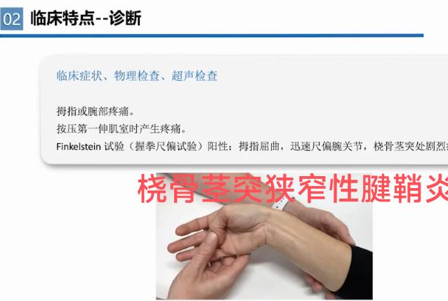 温故而知新。桡骨茎突狭窄性腱鞘炎超声