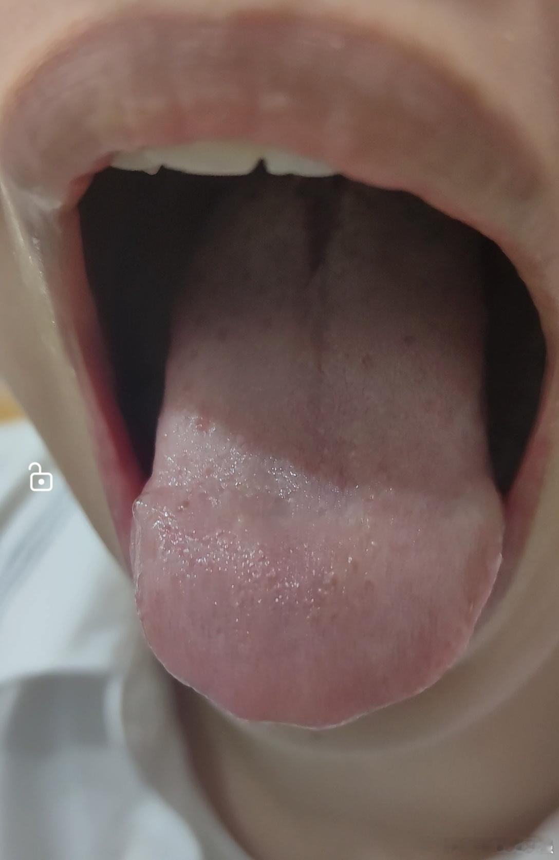这个女孩儿16岁在北京读高一陪她爸爸过来看病给她爸爸看完后让给她女儿也看一下诊脉