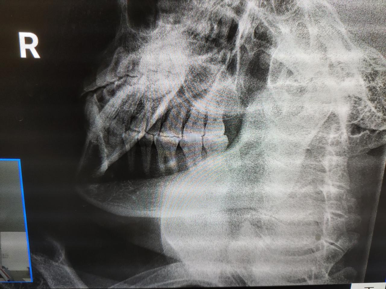 分享我这周有趣的事：
忍不住的牙疼，还是来医院拍片，受不了了，准备拔了
这两个月