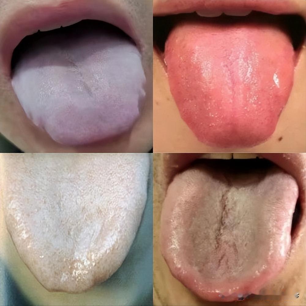 人体四大虚，看舌象辩虚症，你是什么虚？

阳虚就像自然界没有太阳，阳气不足，舌象