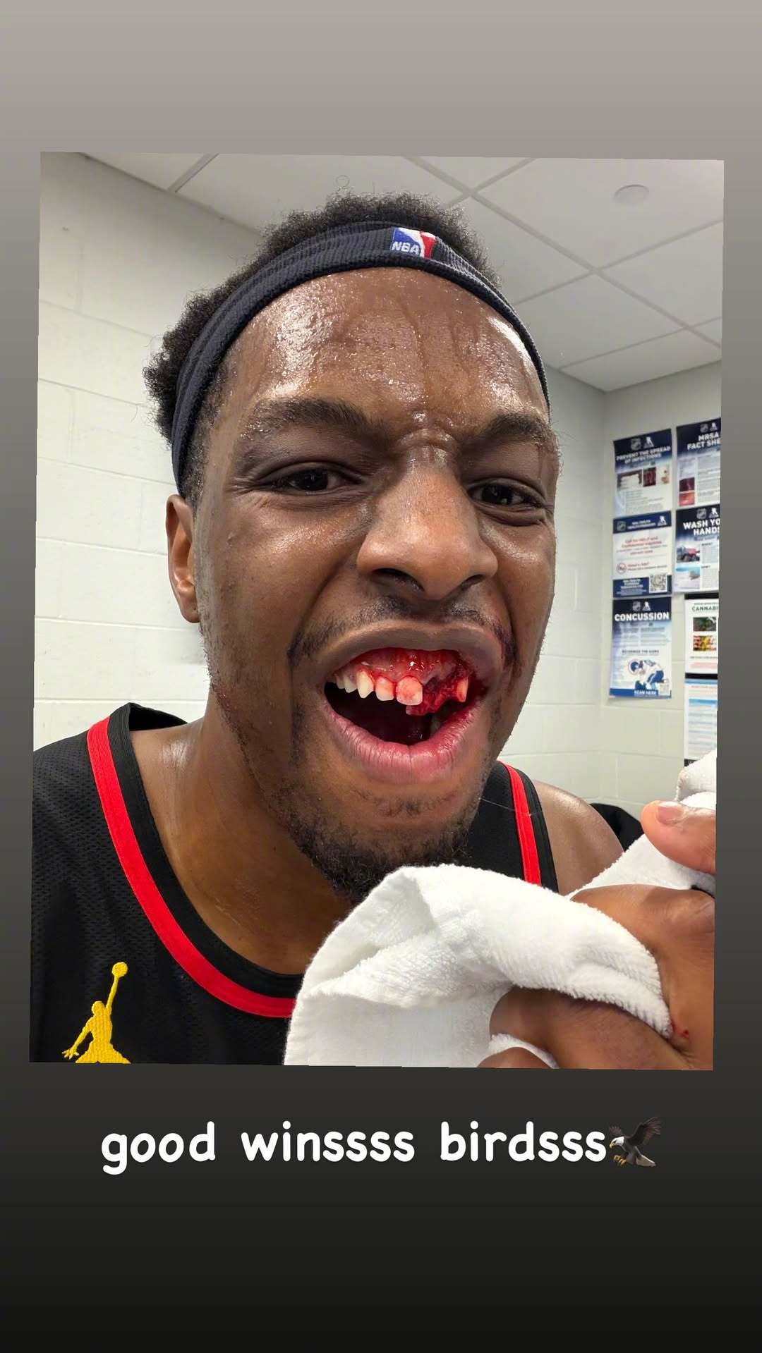 奥孔武被杰伦-布朗肘到满嘴是血回了更衣室，奥孔武自己晒出了照片，太吓人了，两颗牙