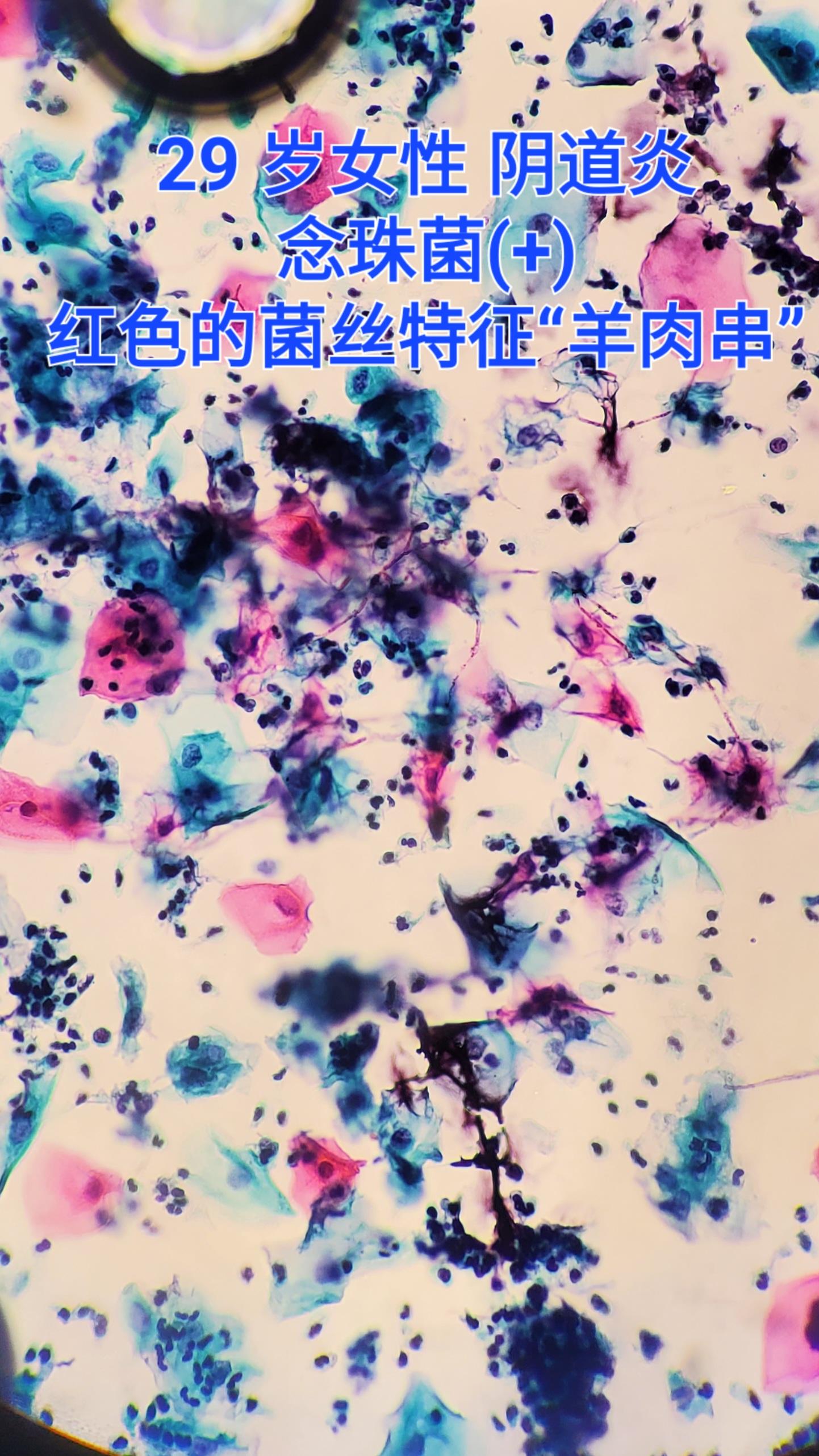 念珠菌阳性