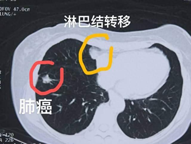 化疗 + 免疫后肿瘤还有活性！冷冻 + 粒子双微创，对付肺癌残余病灶