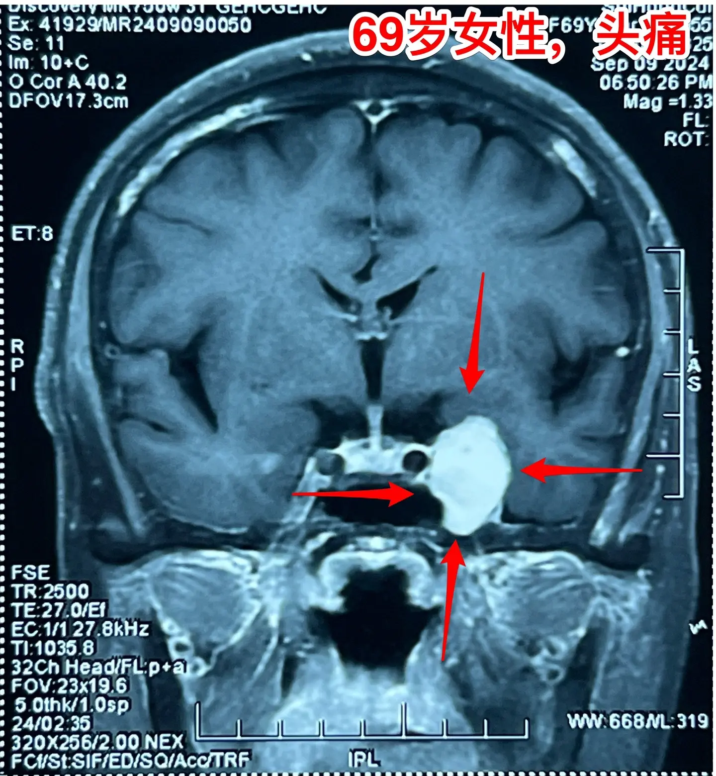 海绵窦区神经鞘瘤，是良性肿瘤。69岁青岛市老太太经常感到头痛，不太剧烈...