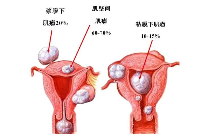 专攻子宫肌瘤的经典用药——桂枝茯苓丸+丹栀逍遥丸

在当今快节奏的生活中，女性健