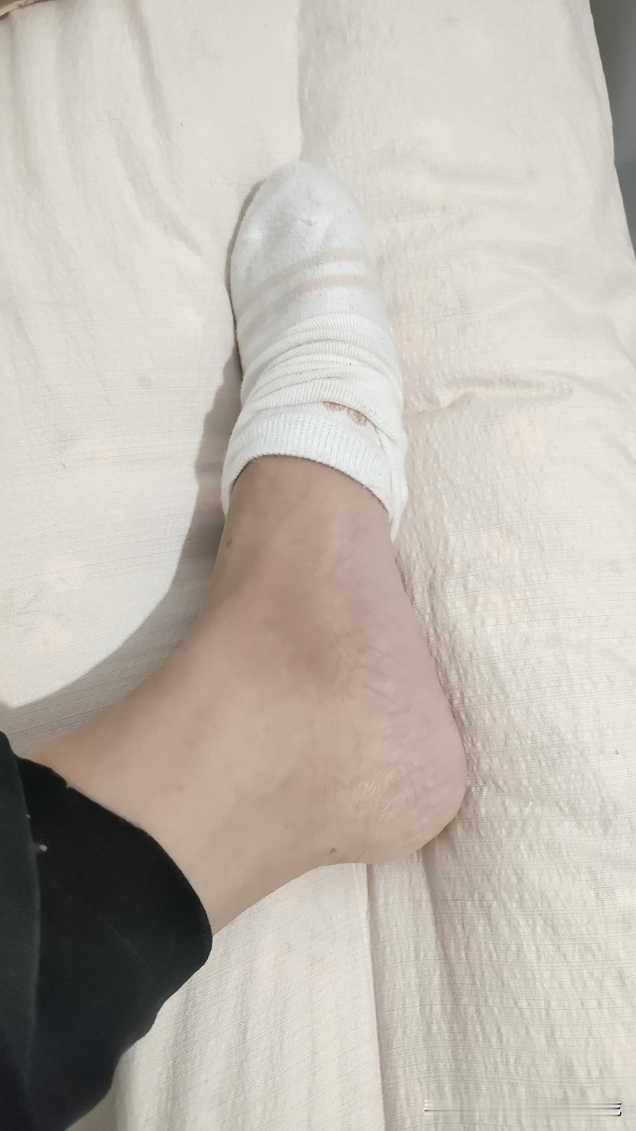 真要被自己蠢哭了，泡脚竟然把脚烫伤了。
昨晚我泡脚时，觉得水有点凉了，就拿起旁边