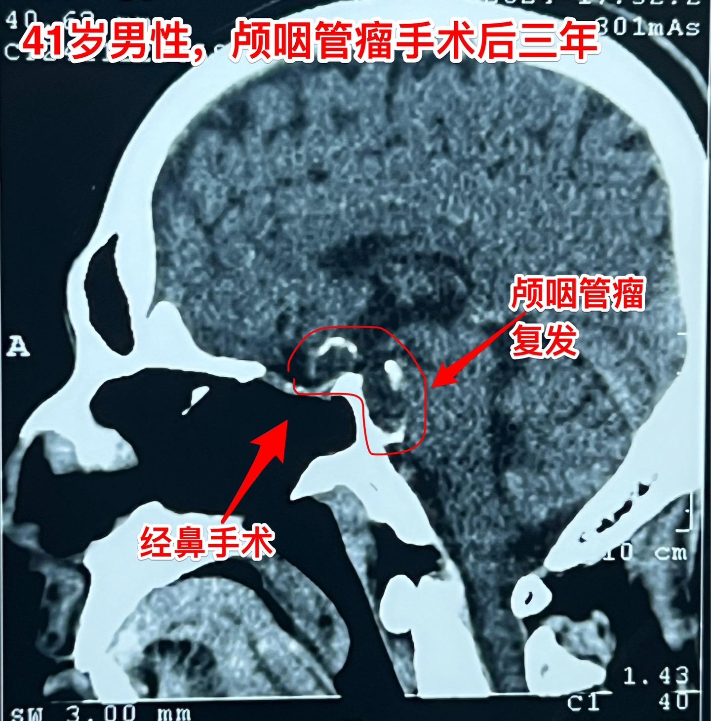 又一个经鼻手术后复发的颅咽管瘤。41岁的大连市男性，三年前因视力下降在...