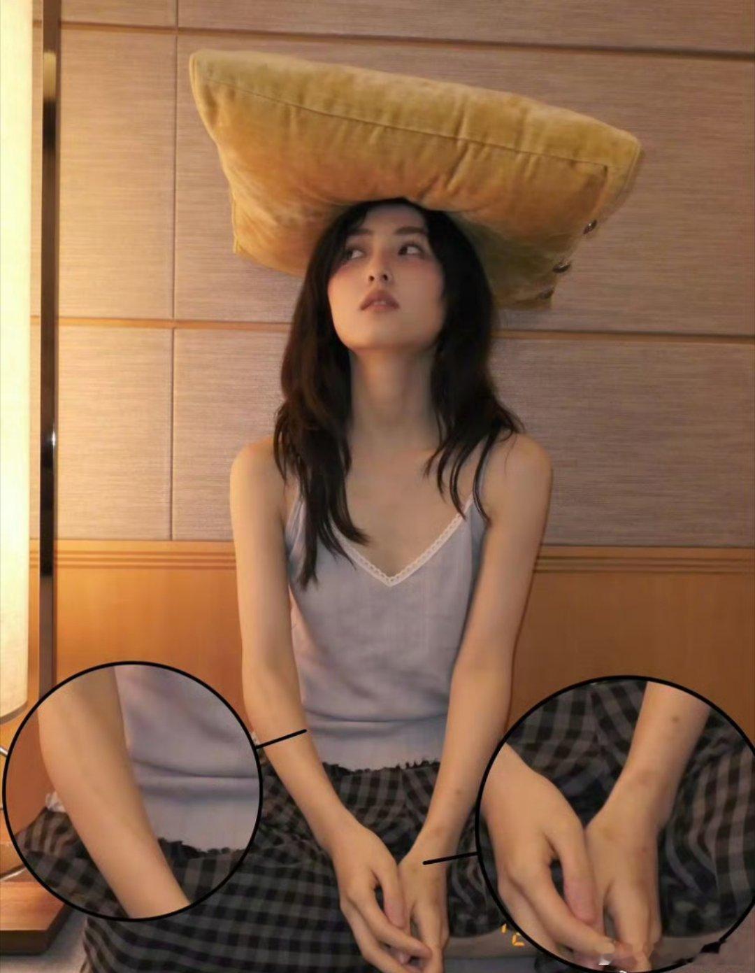 张子枫手臂都是伤疤妹妹是疤痕体质吗，好心疼张子枫 