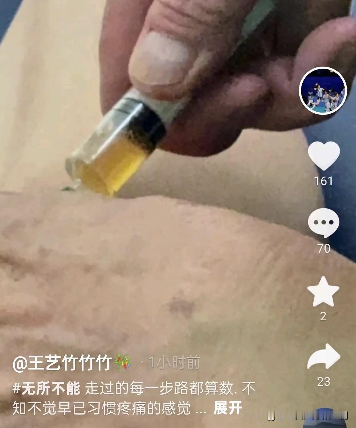近日，王艺竹在社交媒体上放出了自己返回天津后，膝盖被抽取积液的视频，她还发文：不