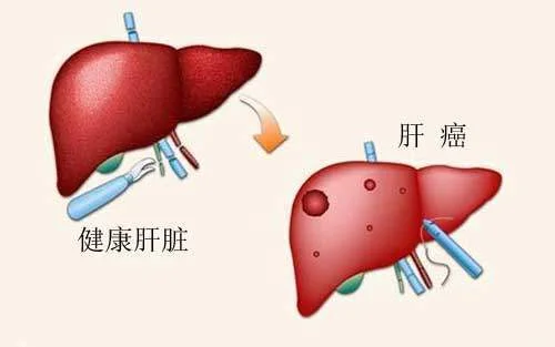 得了乙肝，千万别大意，这个后果你承担不起