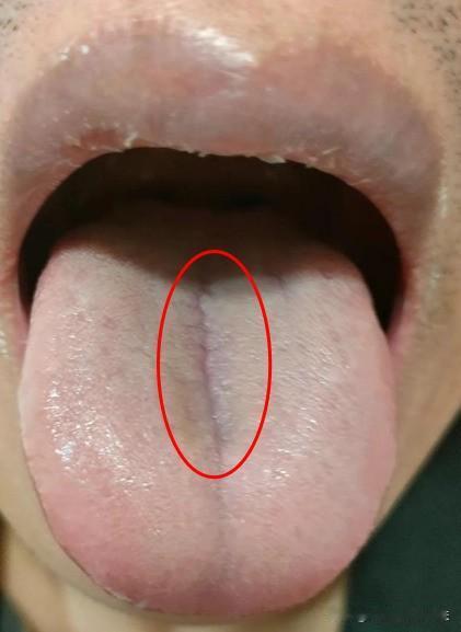 失眠多梦，多是肝郁脾虚？逍遥、柴胡疏肝怎么选？教你1招辨舌象
这个粉丝，最近一段