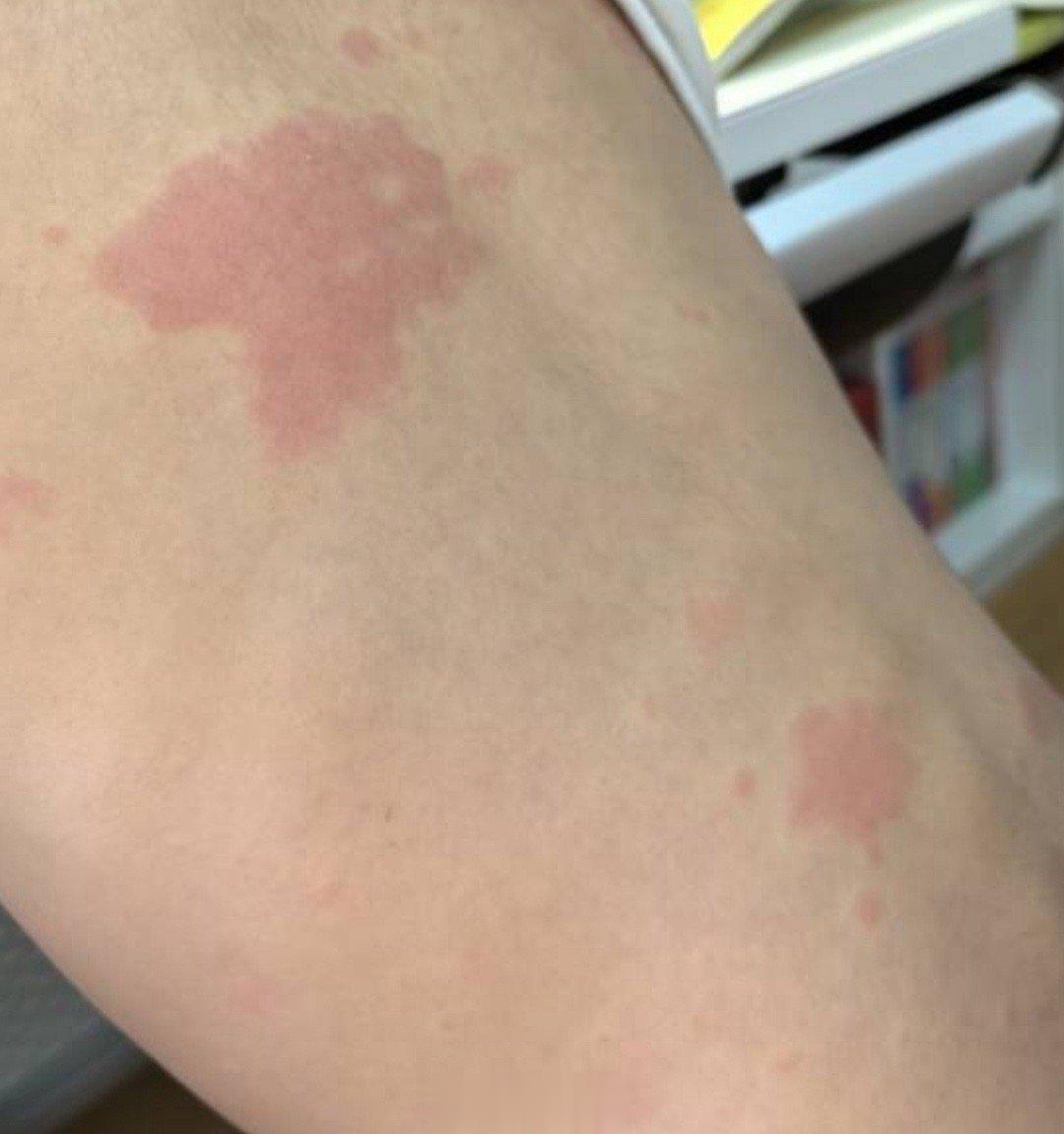 小朋友发烧不高，身上出斑了。这种情况凉血解毒即可，不要发散，不要发汗。 ​​​