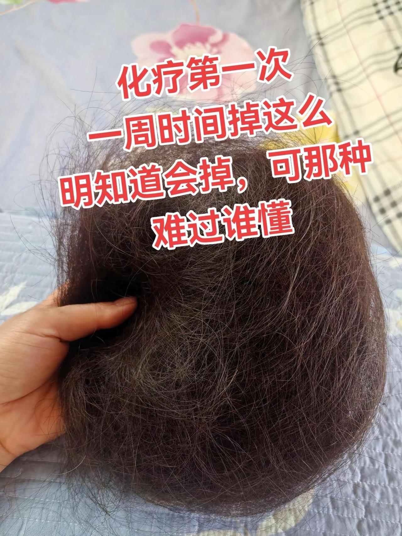 化疗第一次。  

化疗第一次，第13天开始掉头发，  

看着每天一撮一撮掉的